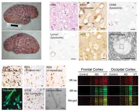 Vacuolar tauopathy