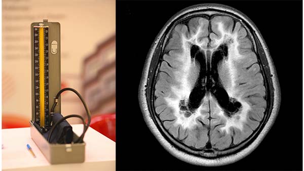 中年期の拡張期高血圧は晩年の脳白質障害に影響する