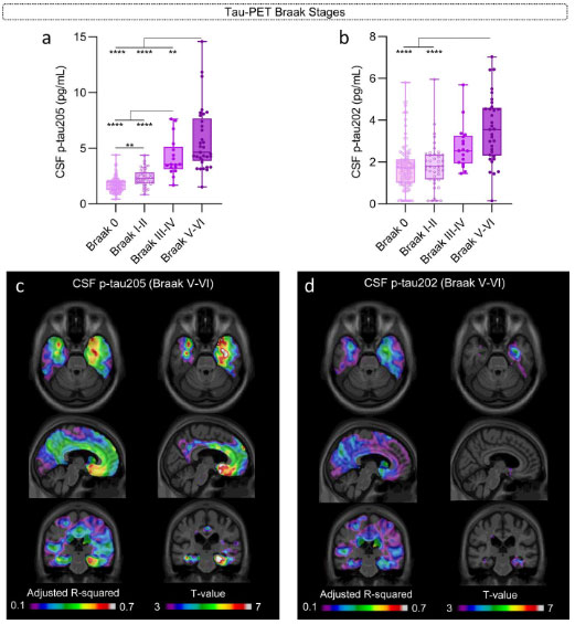 髄液中p-tau205はアルツハイマー病の脳内のタウ病理を反映する