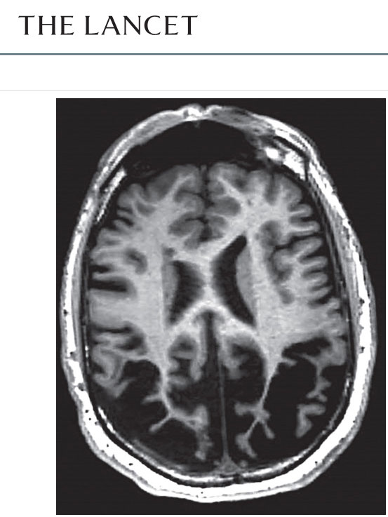 Lancet_Neurol-2024-PCA-1