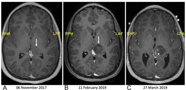 thalamic-incidentaloma-1-3