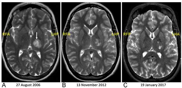 thalamic-incidentaloma-1-4