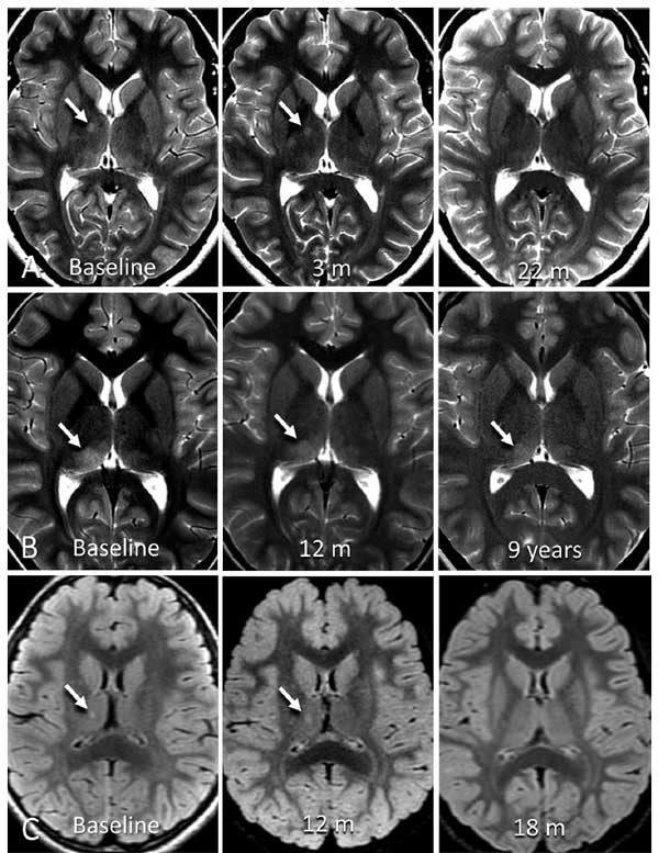 thalamic-incidentaloma-2-4