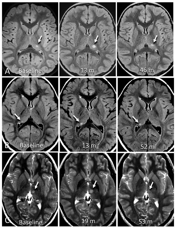 thalamic-incidentaloma-2-3