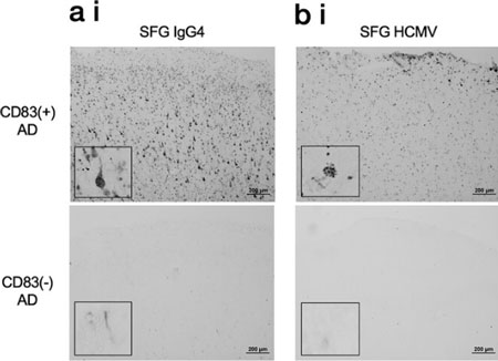 AlzDemenz-2025-CMV-CD83microglia-AD-2